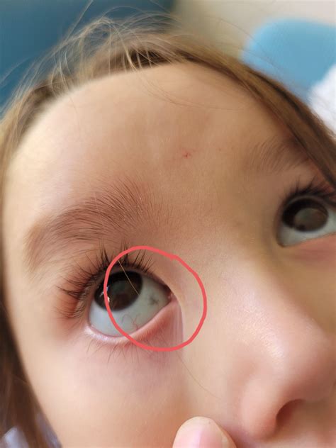 dark spots in eyes children.